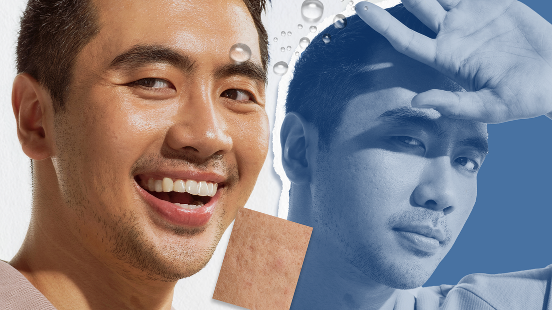 If you think clear skin is out of reach, Landamme says think again