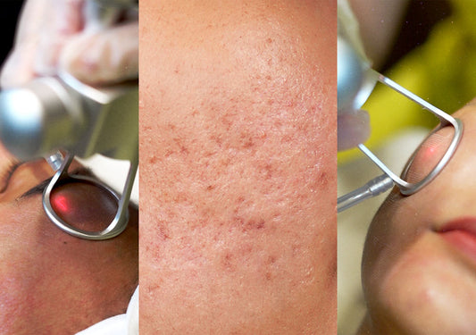 This Isn’t Your Usual CO2 Laser: Remedy’s New Acne Scar Treatment Does More