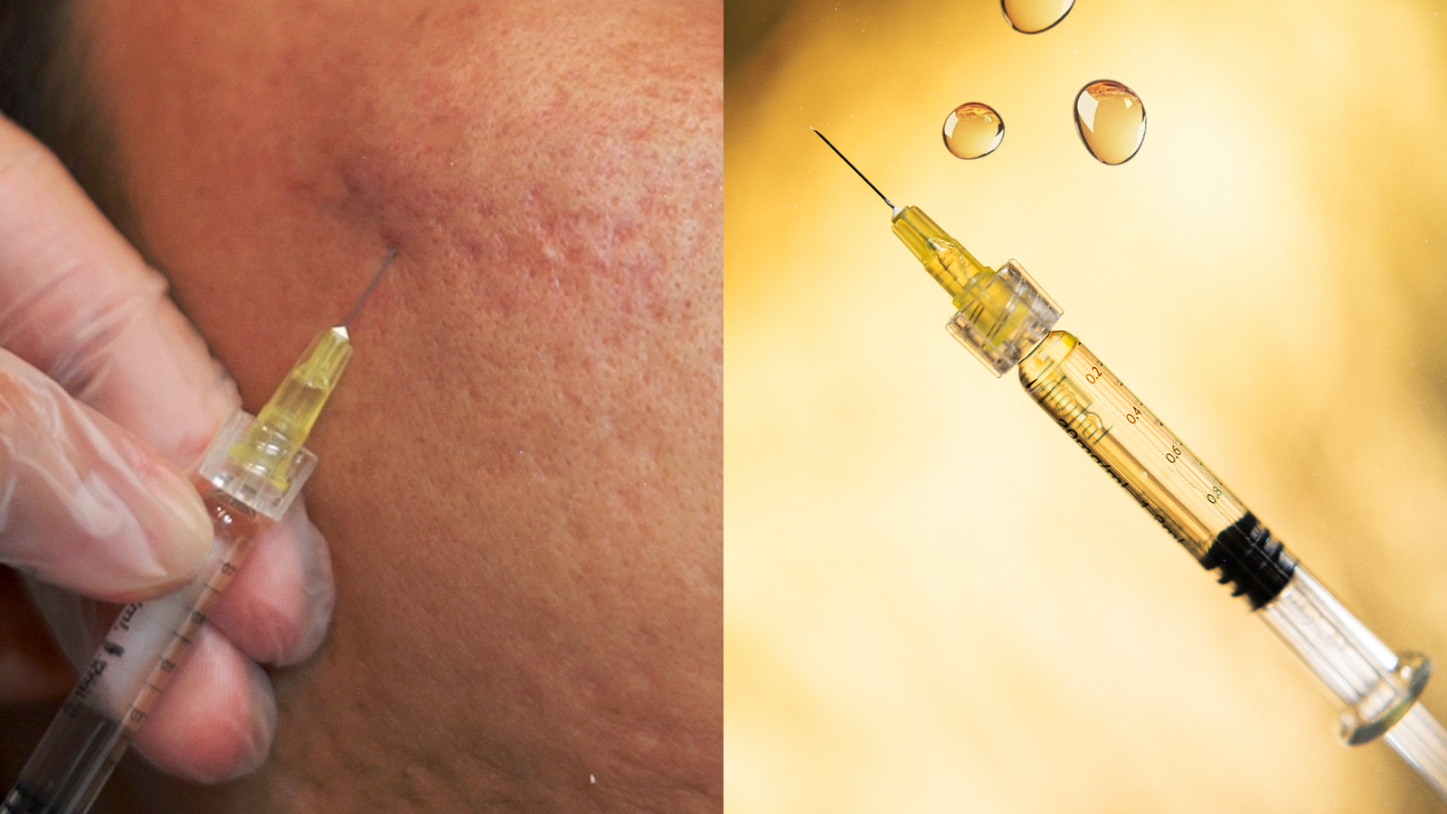 Smooth It Out: Remedy’s Scar Filler Treatment for Indented Acne Scars