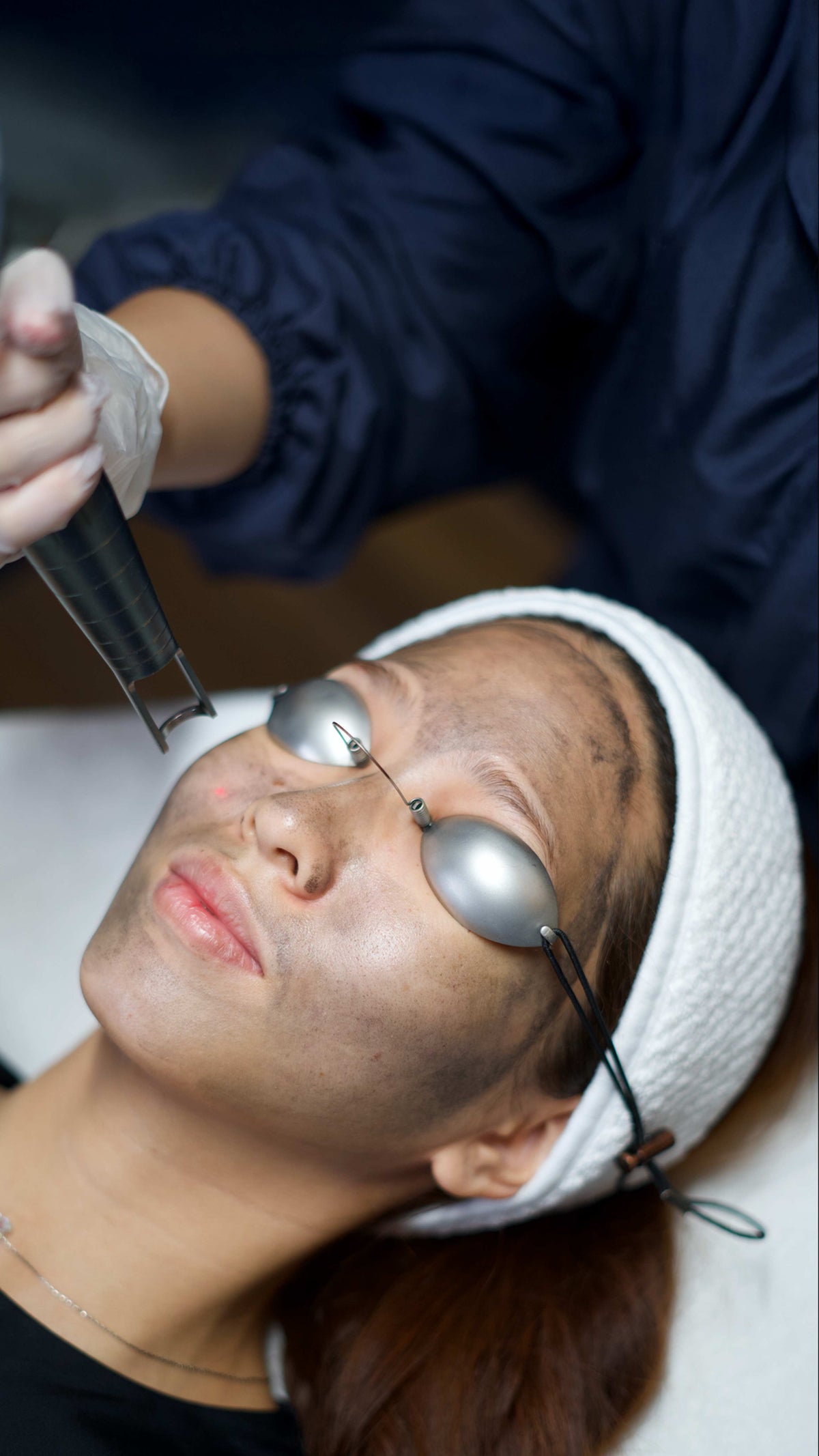 Carbon Laser Facial