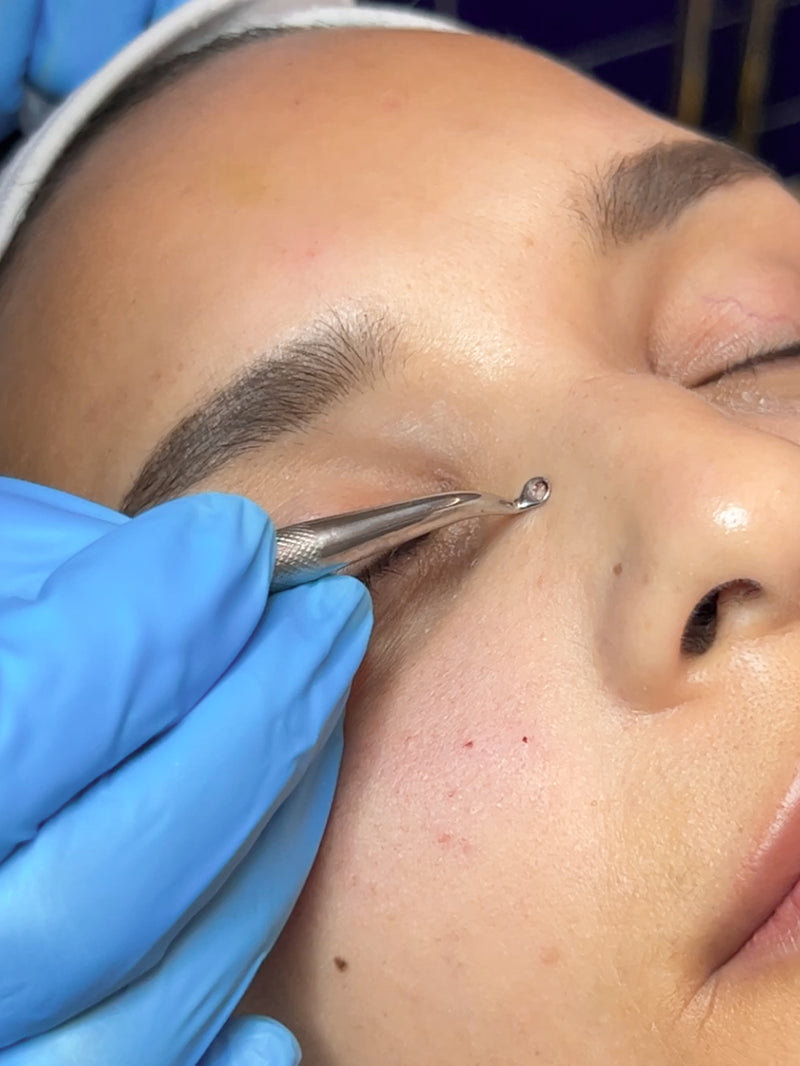 Milia Removal