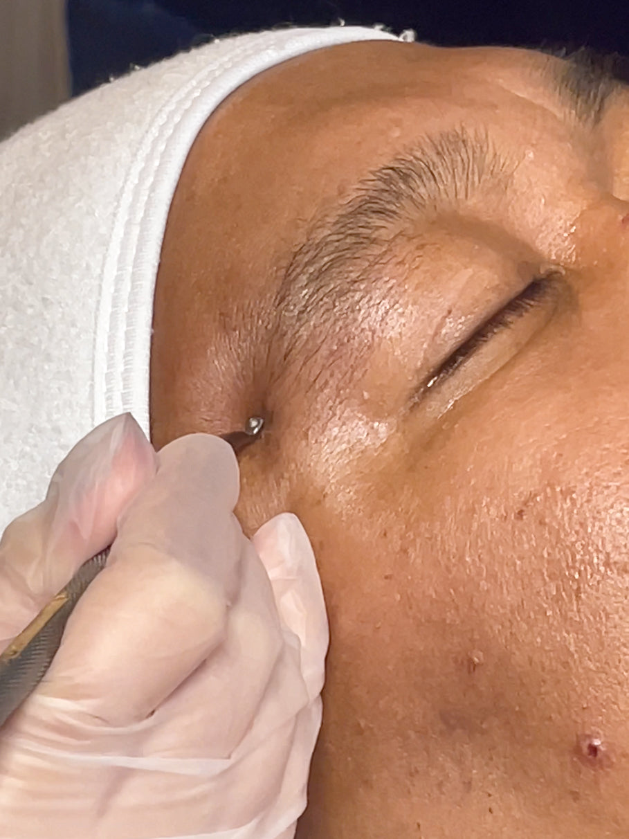 Sebaceous Hyperplasia Removal