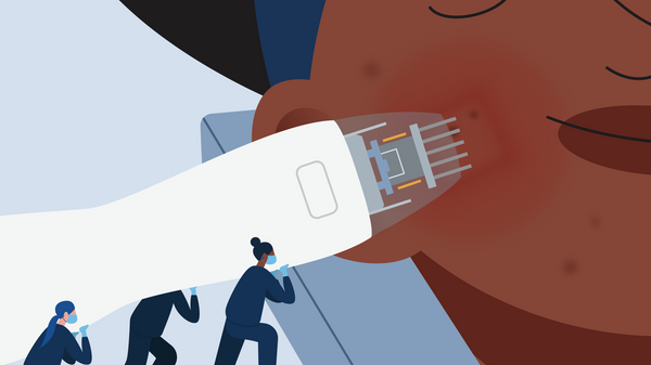 New on the acne scar radar: RF microneedling