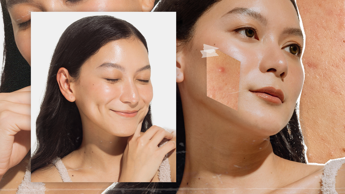 Here’s the routine and remedy this content creator is using to fight adult acne