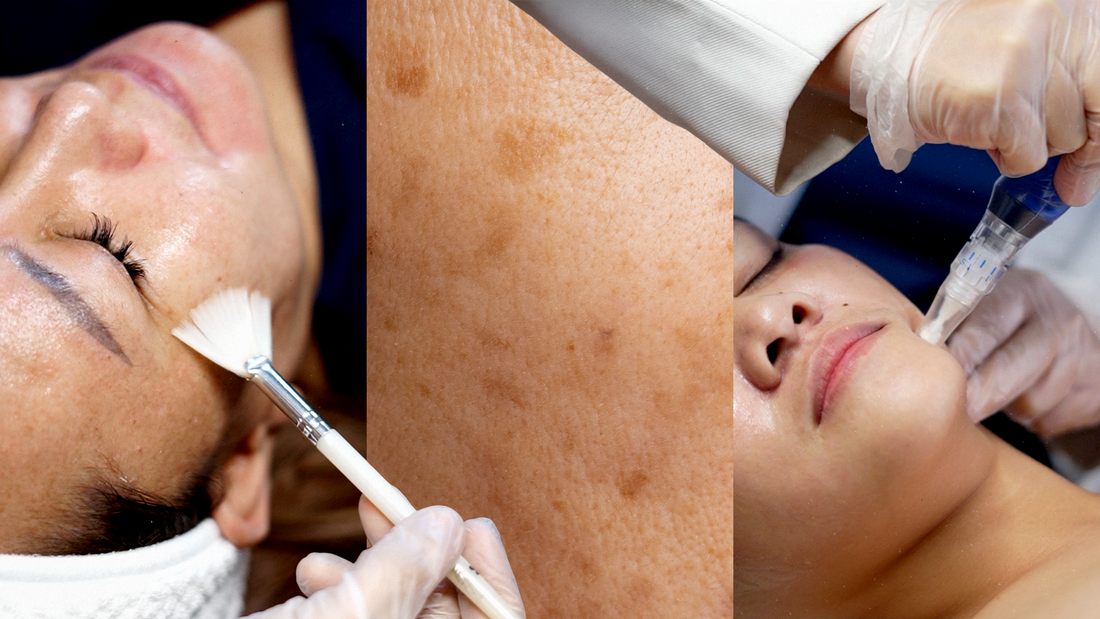 Dark Patches and Flare-ups? Remedy’s Melasma Fade Has You Covered