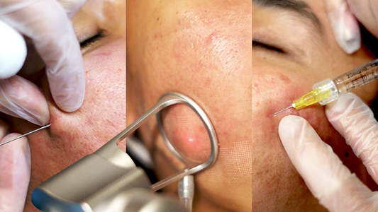 The X-Scar Combos: Remedy’s Smartest Strategy Yet for Acne Scar Correction