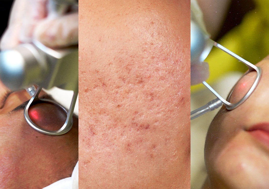 This Isn’t Your Usual CO2 Laser: Remedy’s New Acne Scar Treatment Does More