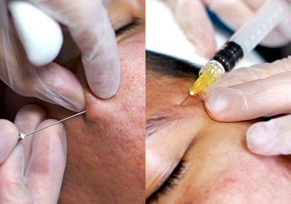 Scar Lift: The Scar Treatment That Goes Deeper and Works Smarter