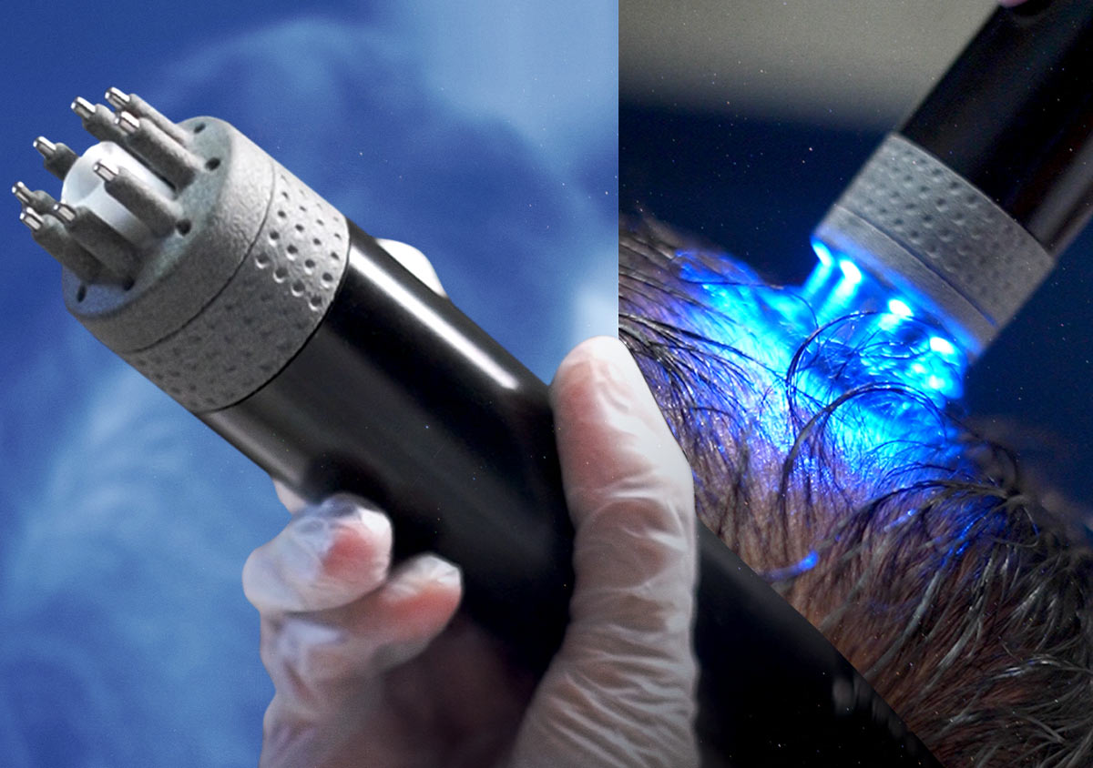 Tricopat at Remedy: The Needle-Free Breakthrough in Hair Regrowth