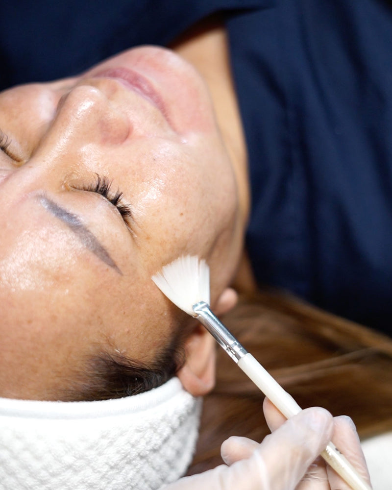 Melasma Peel