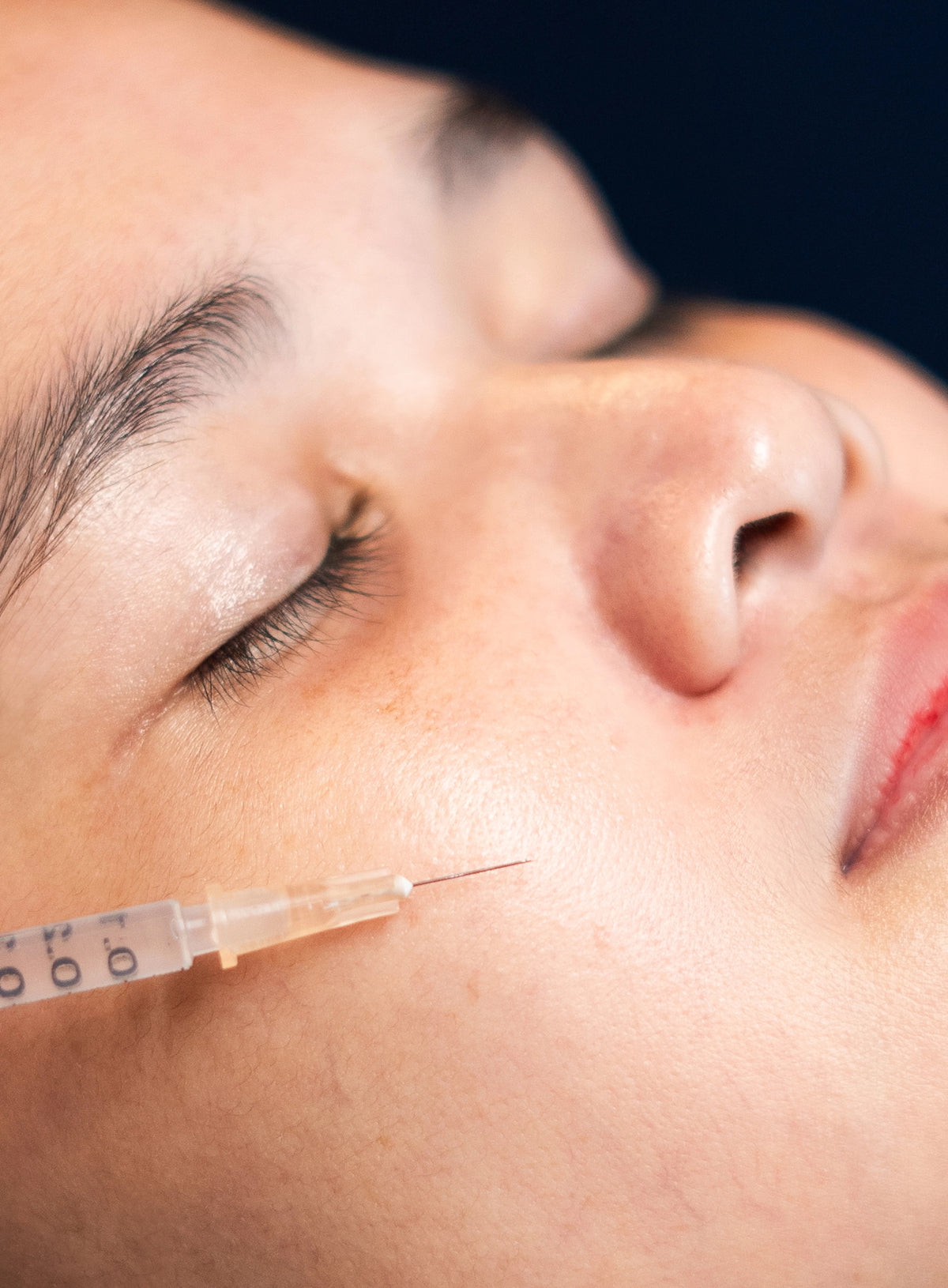 Melasma Fade