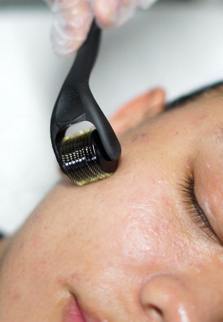 Microneedling