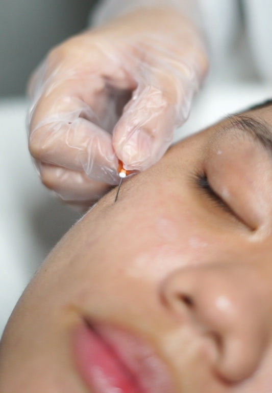 Scar Lift (Cannula Subcision + Biostimulator)