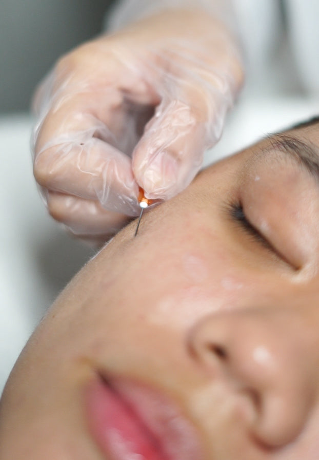 Scar Lift (Cannula Subcision + Biostimulator)